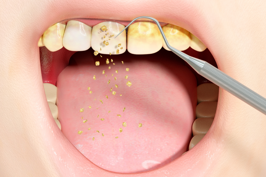 Helicobacter en la placa dental