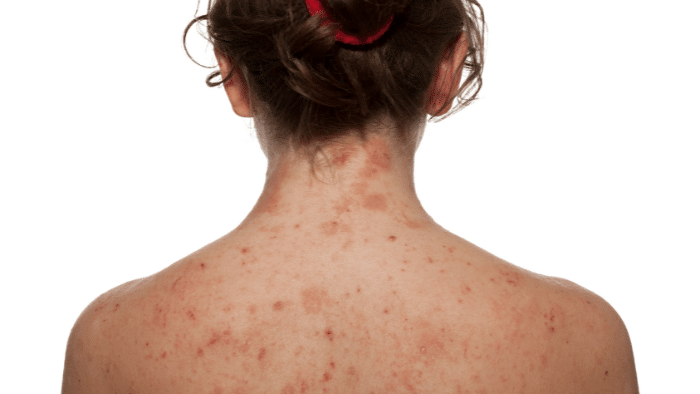 El consumo excesivo de sal podría relacionarse con sufrir dermatitis atópica