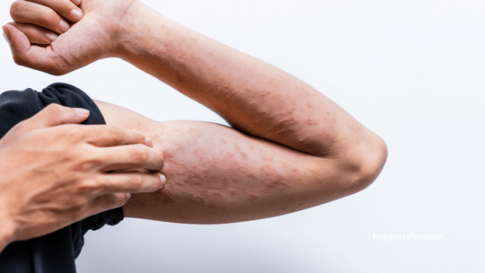 El consumo excesivo de sal podría relacionarse con sufrir dermatitis atópica