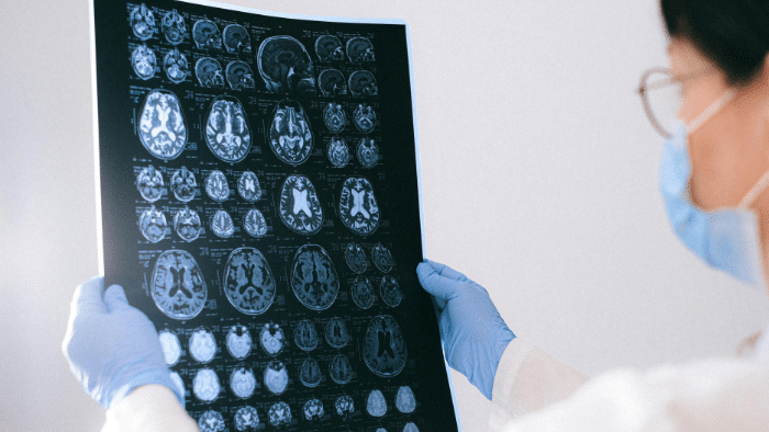 Cromosoma X y envejecimiento: Descubren su papel en la salud cerebral femenina