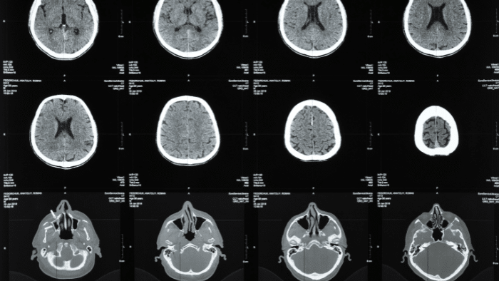 La edición genética cerebral: nuevas terapias para trastornos neurológicos
