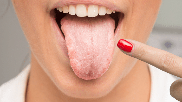Saliva artificial de nueva generación: la proteína de la caña de azúcar que podría cambiar la salud bucalz
