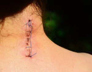 Melanina sintética: la nueva terapia para regenerar la piel y borrar cicatrices