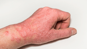 El consumo excesivo de sal podría relacionarse con sufrir dermatitis atópica
