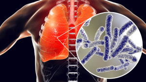 Enfermedad del legionario: Cómo la bacteria Legionella está afectando al mundo