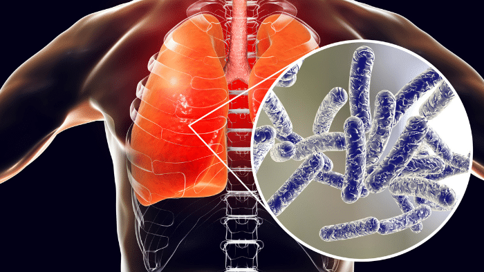 Enfermedad del legionario: Cómo la bacteria Legionella está afectando al mundo