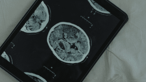 La edición genética cerebral: nuevas terapias para trastornos neurológicos