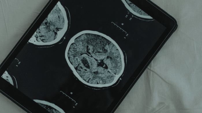 La edición genética cerebral: nuevas terapias para trastornos neurológicos